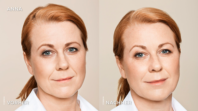 Faltenbehandlung Gesicht Vorher Nachher