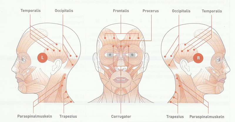 Therapie bei chronischer Migräne mit Botulinum Botox
